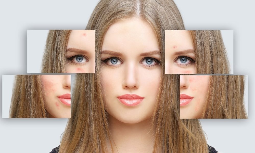 Acne Scars