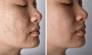Asian female showing results of treatment for her acne scars