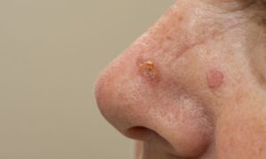 Actinic keratosis on nose