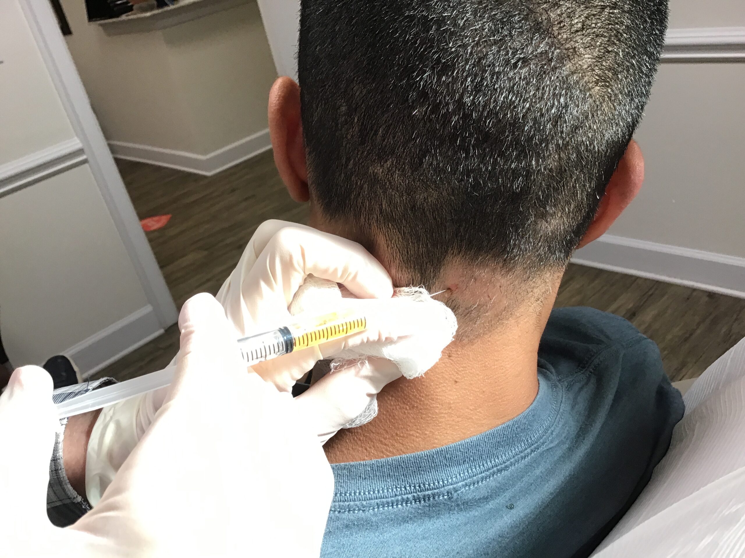 Sept 4, 2020 Injecting an area of alopecia areata