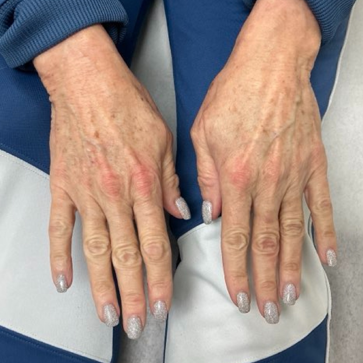IPL_Therapy_hands_before_and_after
