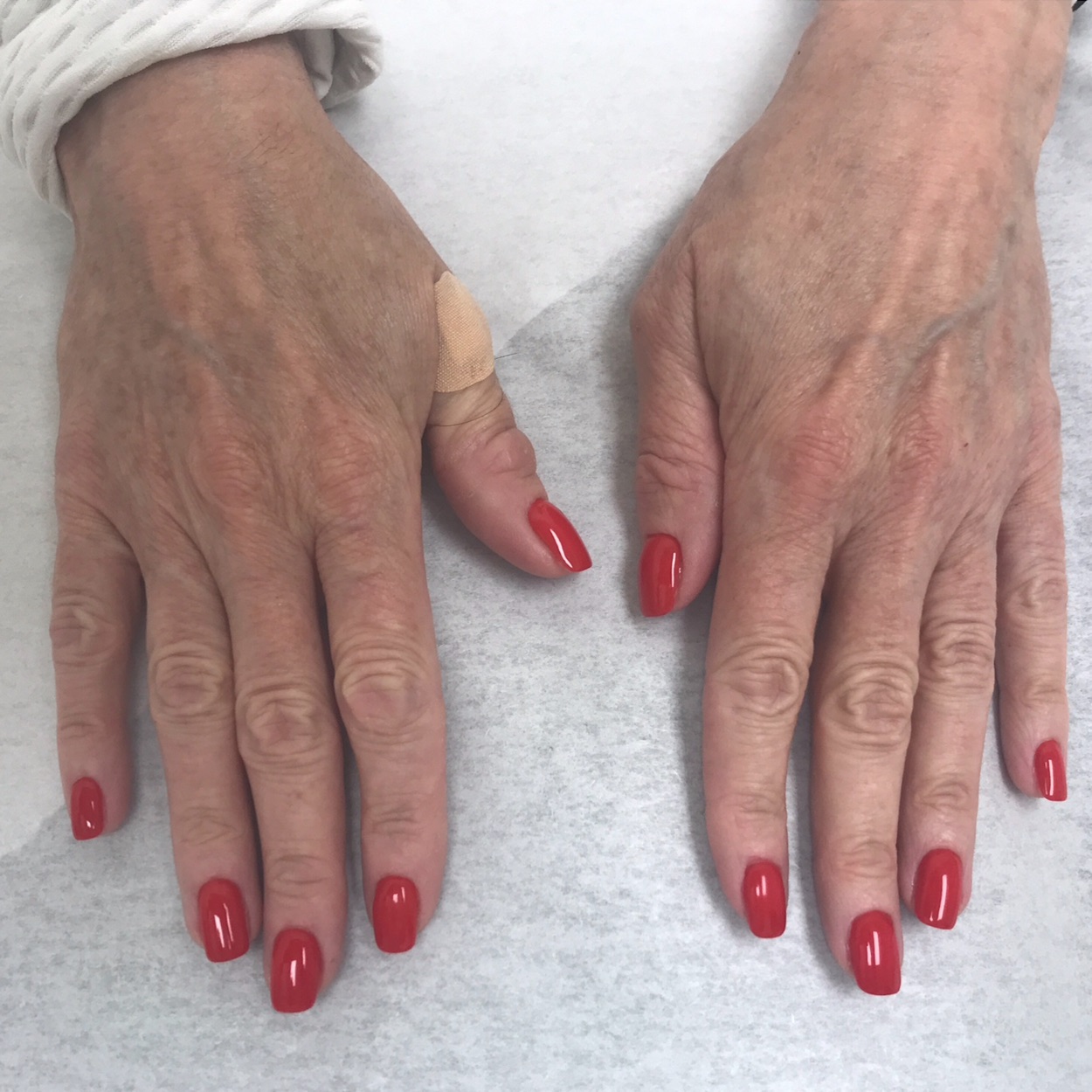 IPL_Therapy_on_hands_before_and_after_results