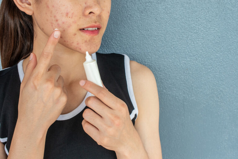 Portrait of woman with acne inflammation (Papule and Pustule) on her face and she trying to applying acne cream on her face for treat.